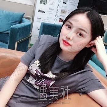 杭州美悦医疗美容正规吗？技术怎么样？隆鼻案例鉴赏