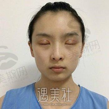 广州都美医疗美容门诊部怎么样？电话|地址|双眼皮案例