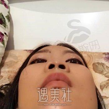 武汉伽美整形美容医院怎么样？地址在哪？鼻修复案例