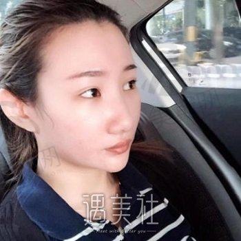 成都长江医院有美容科吗？技术水准怎么样？隆鼻案例鉴赏