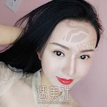 扬州艾菲斯整形美容医院怎么样？正规吗？口碑评价+双眼皮案例