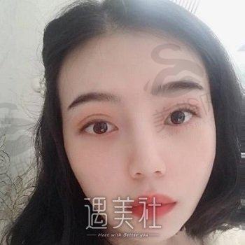 云南华美美莱医疗整形美容医院怎么样？医生信息+全切双眼皮案例