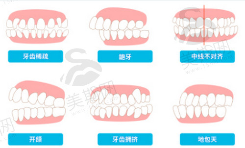 保定市第二医院口腔科牙齿矫正怎么样？详细案例分享+价格表参考