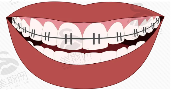 中山大学附属口腔医院牙齿矫正多少钱？隐形矫正，舒适度高！