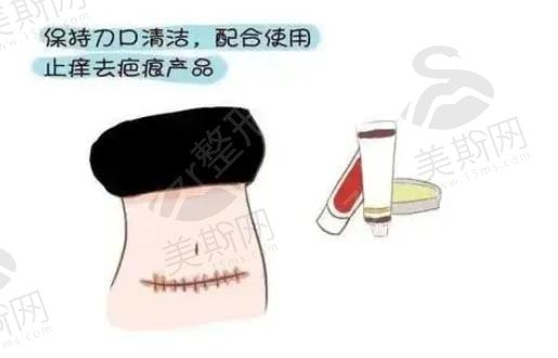 激光去除妊娠纹有效吗，效果如何