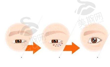 激光去眼袋手术有什么好处，要注意什么