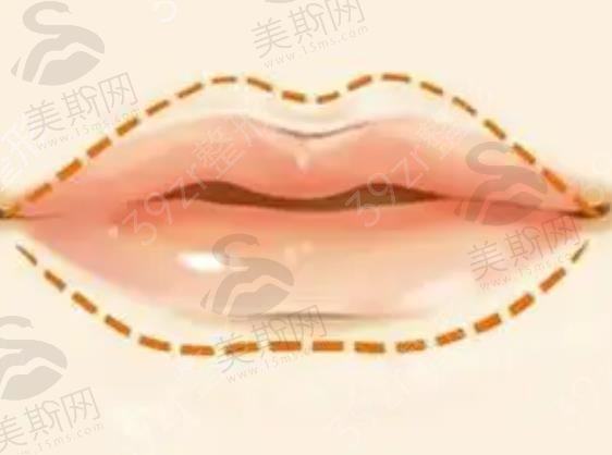 骨性凸嘴怎么办，需要做正颌手术吗