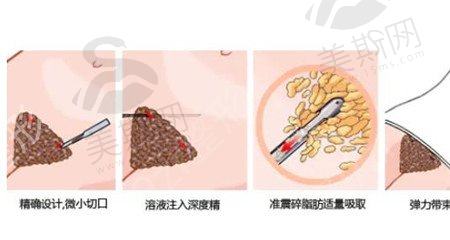 光纤溶脂后会留疤吗？有哪些后遗症