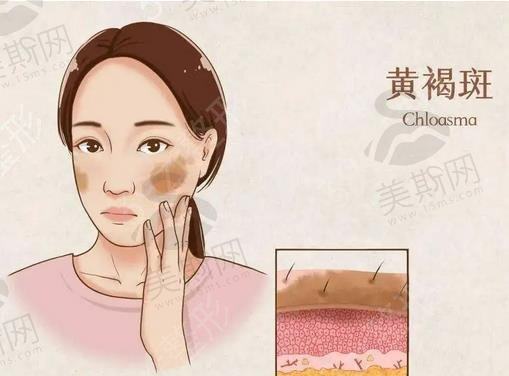 光子嫩肤和激光祛斑有什么区别?