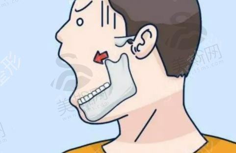 颧骨为什么会外扩？颧骨外扩怎么自然改良？