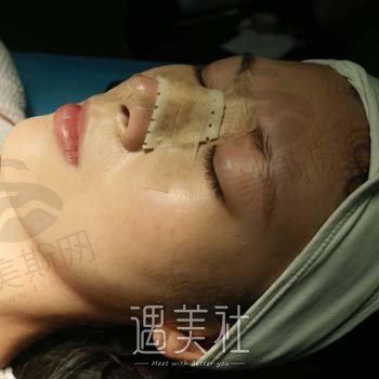 在芜湖壹加壹做半肋骨鼻综合3-6个月恢复期变化图分享