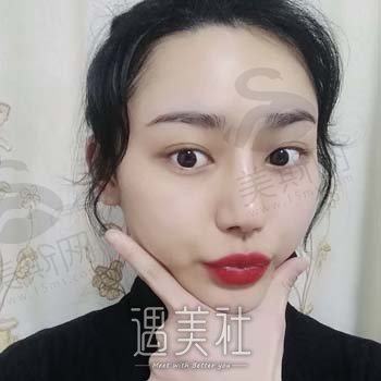 南昌佳美周方宾隆鼻2个月恢复过程，全过程一览