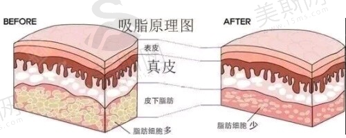 澳洋医院整形科抽脂吸脂怎么样？内含案例分享+医院价目参考