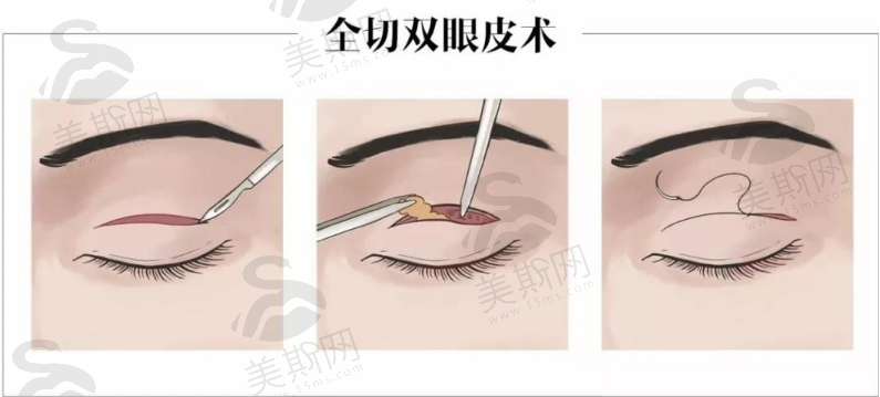 北京八大处割双眼皮怎么样？实力医院技术信息在线浏览