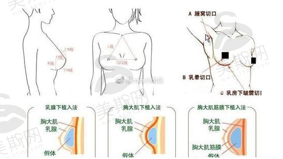 内江市第一人民医院整形外科假体隆胸靠谱吗？详细价格表收费明细一览