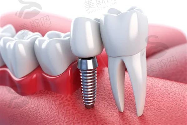 牙结石能否进行洗牙？洗牙对牙结石的影响是什么？