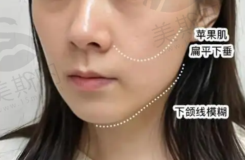 下颌线提升前后对比：真实案例揭示效果与维持时间，助你重塑精致面容！