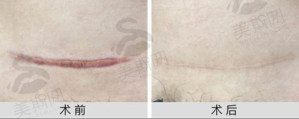 2025广州曙光疤痕修复价格表查询，来看这样的祛疤费用下疤痕修复咋样成效大揭秘
