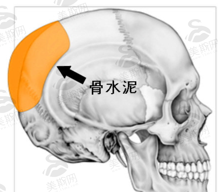 想找何照华做后脑勺填充？那得在线预约北京联合丽格第一整形医院，他经验足技术稳！