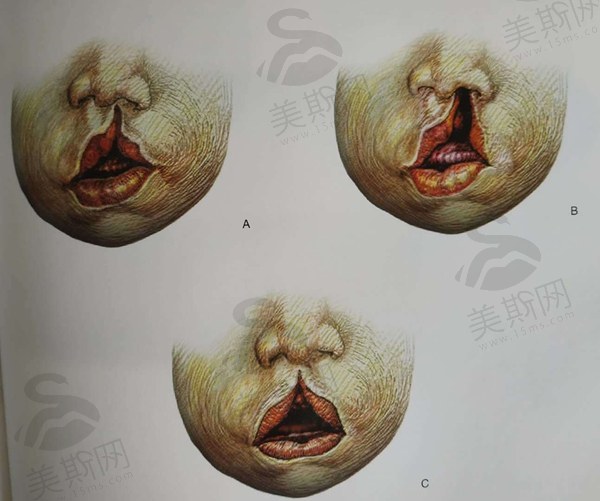 唇腭裂修复手术最佳时间是什么时候？3-6个月、1岁及15-18岁各有讲究！