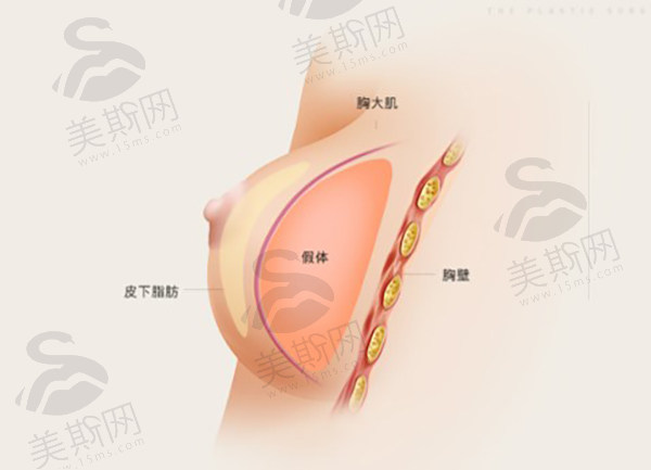 惊叹！广州中家医朱云院长筋膜层丰胸案例：深V乳沟+躺平不假，效果绝了！
