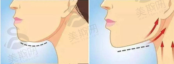 何晋龙下颌角手术变化大吗？亲身经历分享，术后脸型改善明显，价格也合理！