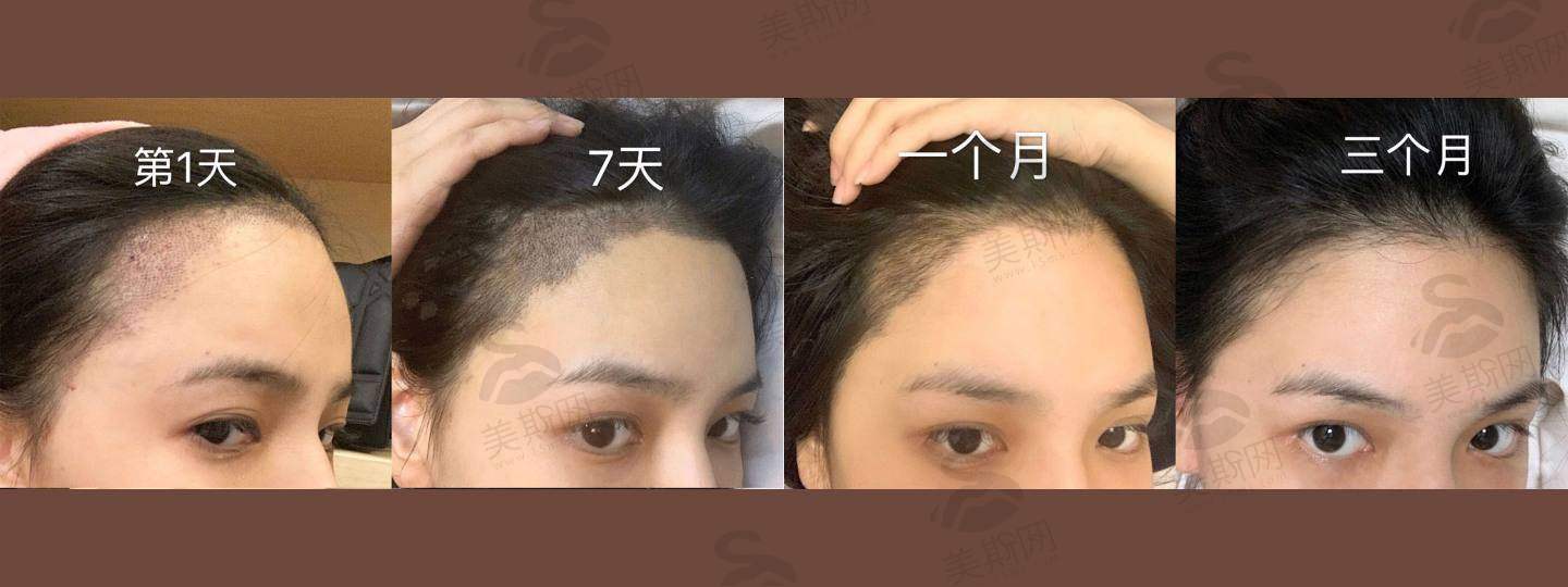 北京奥尔贝德整形连燕峰医生做植发手术10元起/单位！技术精湛效果惊艳，速来了解！