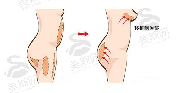 北京韦元强自体脂肪丰胸贵吗?2025年专家推荐及口碑排名,附带丰胸医院名单和在线预约信息!
