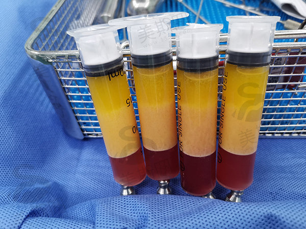 【真实记录】冯斌抽脂记录：讲讲和普通抽脂的区别，价格贵但效果太值了
