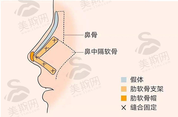 北京奥尔贝德整形姚然医生做鼻综合整形58000起！实力派医生打造惊艳效果，速看！