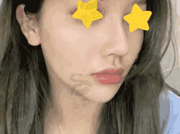 北京王晓健做人中缩短怎么样？生物胶缝合不留疤，1.28w起超香不翻车
