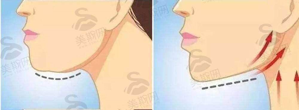 惊叹！杭州颌面高俊明失败修复实例日记：告别脸歪，看他如何妙手回春重塑美丽！