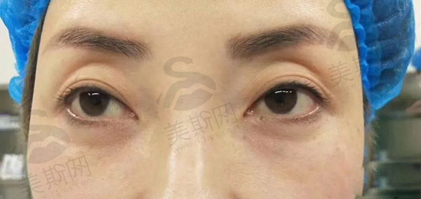 惊叹！成都西区医院邓东伟医生做全切双眼皮修复亲身日记：效果咋样及花费多少全分享