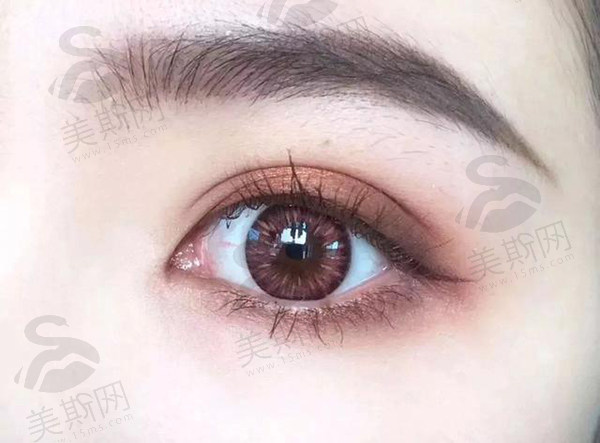 【真实分享】成都中医大银海整形双眼皮修复，附刘辅容坐诊预约及医院评价