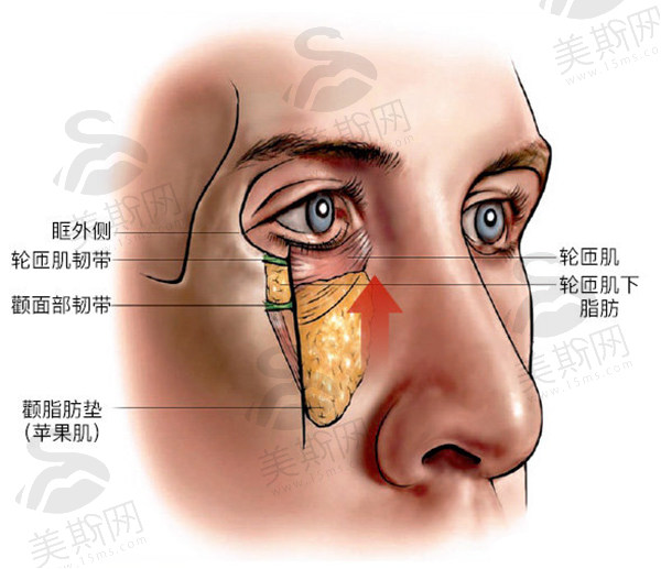 北京陈凤超医生做面部提升价格59800起！精湛技术打造惊艳效果，还能修复双眼皮？