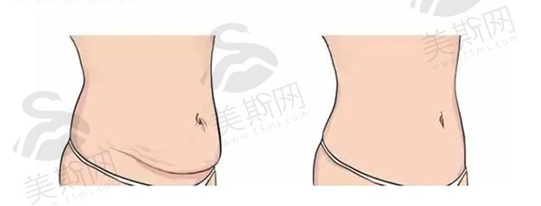 成都八大处整形侯典举医生做腹壁成型价格5w起！技术优势尽显，患者好评如潮？