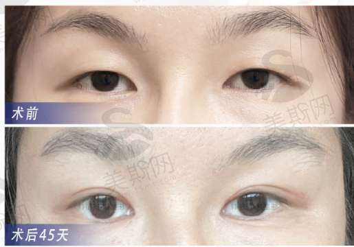 北京师丽丽双眼皮修复技术好吗？20年经验实力见证，实例可信度与价格全解析
