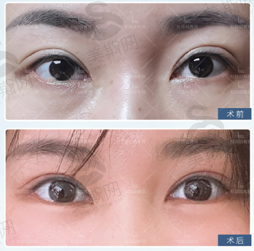 杜园园眼部修复真实经历分享，等了1周才预约上，微创修复宽变窄超靠谱真人实例多