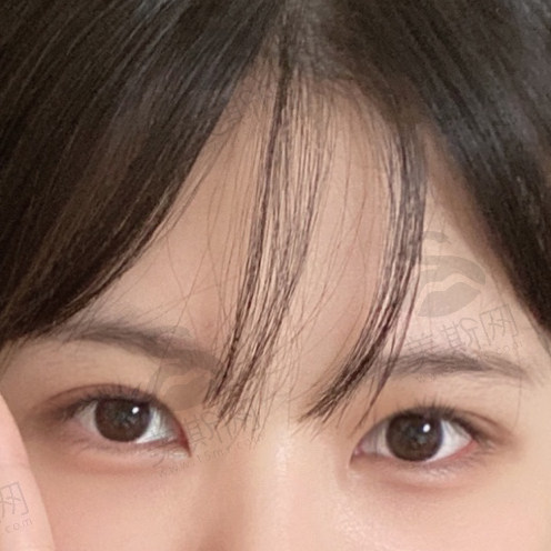 惊叹！韩国来丽医院双眼皮改单眼皮例子：全切改单超自然，见证神奇手术蜕变