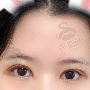 【真实分享】北京魏志香医生的BER包内眼角手术技术真是挺过关的，附详细修复案例！
