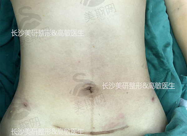北京画美王慧文医生做吸脂塑形价格7800起！跻身2025画美热门医生名单超靠谱