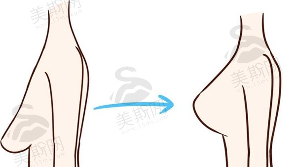 罗盛康教授做乳房下垂矫正术究竟有多牛？真实范例揭秘“无痕蜕变”的秘密