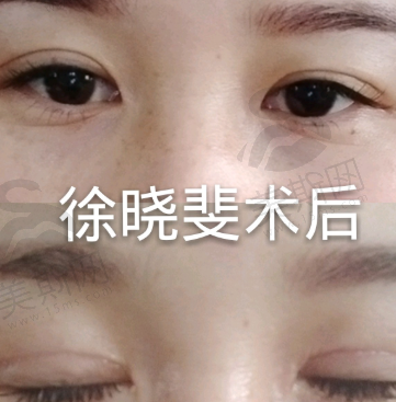 上海徐晓斐修复双眼皮技术怎么样？原来是国内前十，Park法修复口碑超赞