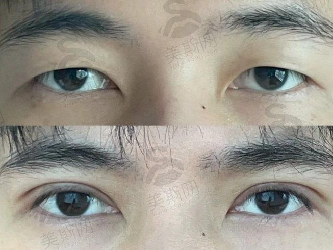 侣同帅医生双眼皮案例：定制眼综合无肉条感，口碑见证修复及价格优势