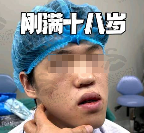 何晋龙正颌真人案例分享：术后改善超惊艳，亲身验证他正颌技术真牛！