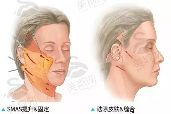 穆宝安面部提升案例分享：从“褶子精”到“冻龄女神”，效果竟能维持这么久！