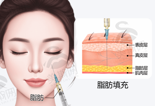成都八大处整形刘珍君医生做脂肪填充价格1.5w起！效果惊艳技术优，这家医院实力究竟如何？