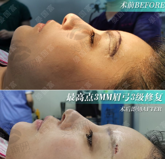 成都眉弓做得好的医生晏国富，膨体丰眉弓价格实惠，效果出众值得一试！