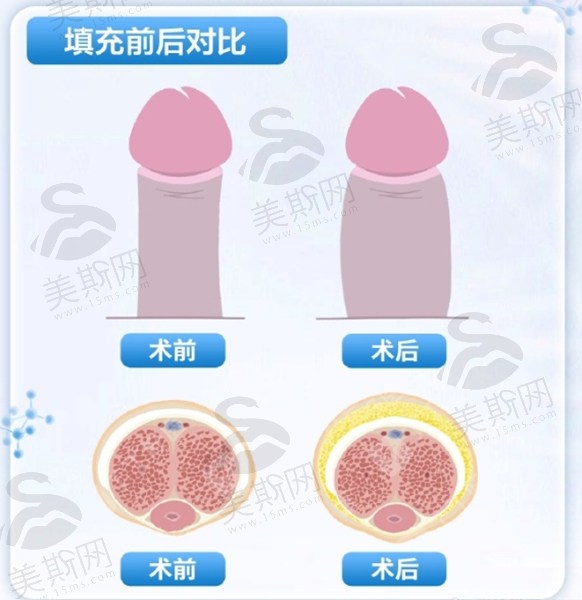 金华丁丁延长增粗手术要多少钱？揭秘丁丁手术延长术费用及地区价格差异！