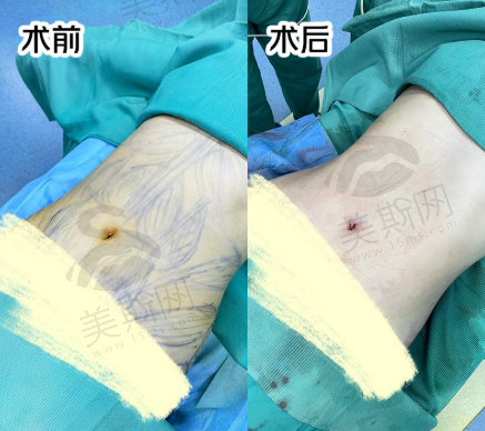 哇塞！陈星光医生吸脂失败为0，快来揭秘他在深圳艺星的神奇整形秘籍